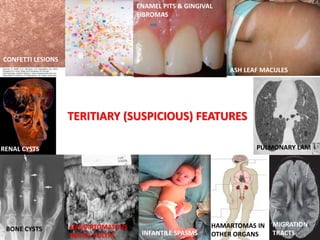 TERITIARY (SUSPICIOUS) FEATURES
CONFETTI LESIONS
ASH LEAF MACULES
ENAMEL PITS & GINGIVAL
FIBROMAS
RENAL CYSTS PULMONARY LAM
HAMARTOMATOUS
RECTAL POLYPS
BONE CYSTS
INFANTILE SPASMS
HAMARTOMAS IN
OTHER ORGANS
MIGRATION
TRACTS
 