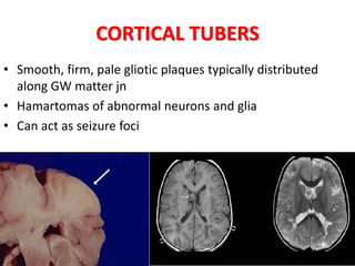 • Smooth, firm, pale gliotic plaques typically distributed
along GW matter jn
• Hamartomas of abnormal neurons and glia
• Can act as seizure foci
CORTICAL TUBERS
 