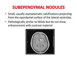 SUBEPENDYMAL NODULES
• Small, usually asymptomatic calcifications projecting
from the ependymal surface of the lateral ventricles.
• Pathologically similar to SEGAs but do not show
enhancement with contrast material
 