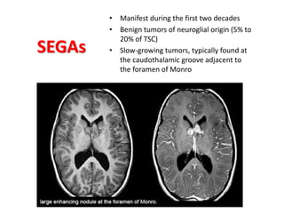 SEGAs
• Manifest during the first two decades
• Benign tumors of neuroglial origin (5% to
20% of TSC)
• Slow-growing tumors, typically found at
the caudothalamic groove adjacent to
the foramen of Monro
 