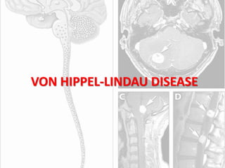 VON HIPPEL-LINDAU DISEASE
 