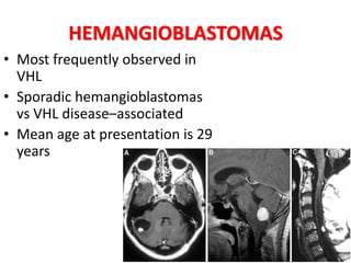 HEMANGIOBLASTOMAS
• Most frequently observed in
VHL
• Sporadic hemangioblastomas
vs VHL disease–associated
• Mean age at presentation is 29
years
 