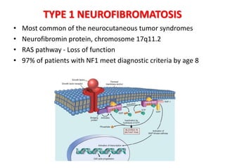 TYPE 1 NEUROFIBROMATOSIS
• Most common of the neurocutaneous tumor syndromes
• Neurofibromin protein, chromosome 17q11.2
• RAS pathway - Loss of function
• 97% of patients with NF1 meet diagnostic criteria by age 8
 