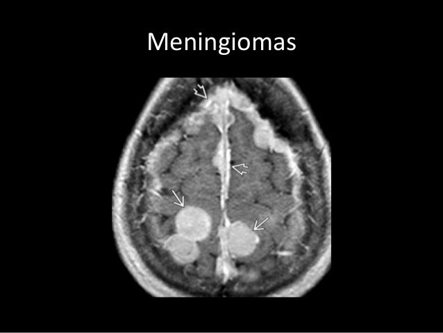 Imaging in Phakomatoses