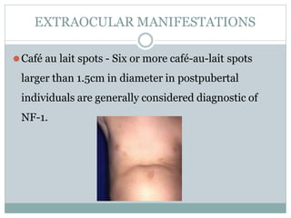 EXTRAOCULAR MANIFESTATIONS
⚫Café au lait spots - Six or more café-au-lait spots
larger than 1.5cm in diameter in postpubertal
individuals are generally considered diagnostic of
NF-1.
 