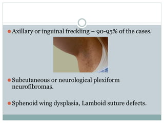 ⚫Axillary or inguinal freckling – 90-95% of the cases.
⚫Subcutaneous or neurological plexiform
neurofibromas.
⚫Sphenoid wing dysplasia, Lamboid suture defects.
 