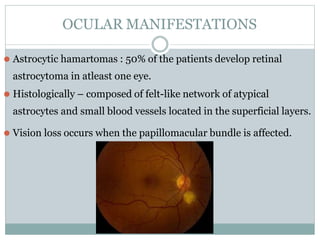 OCULAR MANIFESTATIONS
⚫ Astrocytic hamartomas : 50% of the patients develop retinal
astrocytoma in atleast one eye.
⚫ Histologically – composed of felt-like network of atypical
astrocytes and small blood vessels located in the superficial layers.
⚫ Vision loss occurs when the papillomacular bundle is affected.
 