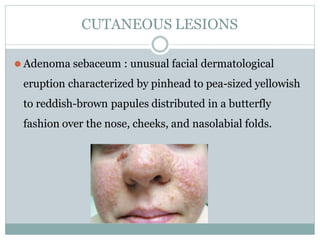 CUTANEOUS LESIONS
⚫ Adenoma sebaceum : unusual facial dermatological
eruption characterized by pinhead to pea-sized yellowish
to reddish-brown papules distributed in a butterfly
fashion over the nose, cheeks, and nasolabial folds.
 