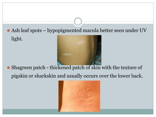 ⚫ Ash leaf spots – hypopigmented macula better seen under UV
light.
⚫ Shagreen patch - thickened patch of skin with the texture of
pigskin or sharkskin and usually occurs over the lower back.
 