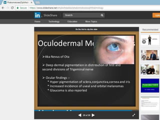 OCULODERMAL MELANOCYTOSIS
 