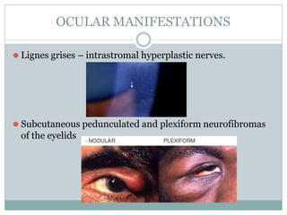 OCULAR MANIFESTATIONS
⚫ Lignes grises – intrastromal hyperplastic nerves.
⚫ Subcutaneous pedunculated and plexiform neurofibromas
of the eyelids
 