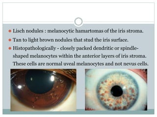 ⚫ Lisch nodules : melanocytic hamartomas of the iris stroma.
⚫ Tan to light brown nodules that stud the iris surface.
⚫ Histopathologically - closely packed dendritic or spindle-
shaped melanocytes within the anterior layers of iris stroma.
These cells are normal uveal melanocytes and not nevus cells.
 