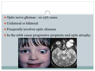 ⚫ Optic nerve gliomas : 10-15% cases.
⚫ Unilateral or bilateral
⚫ Frequently involves optic chiasma
⚫ In the orbit cause progressive proptosis and optic atrophy.
 