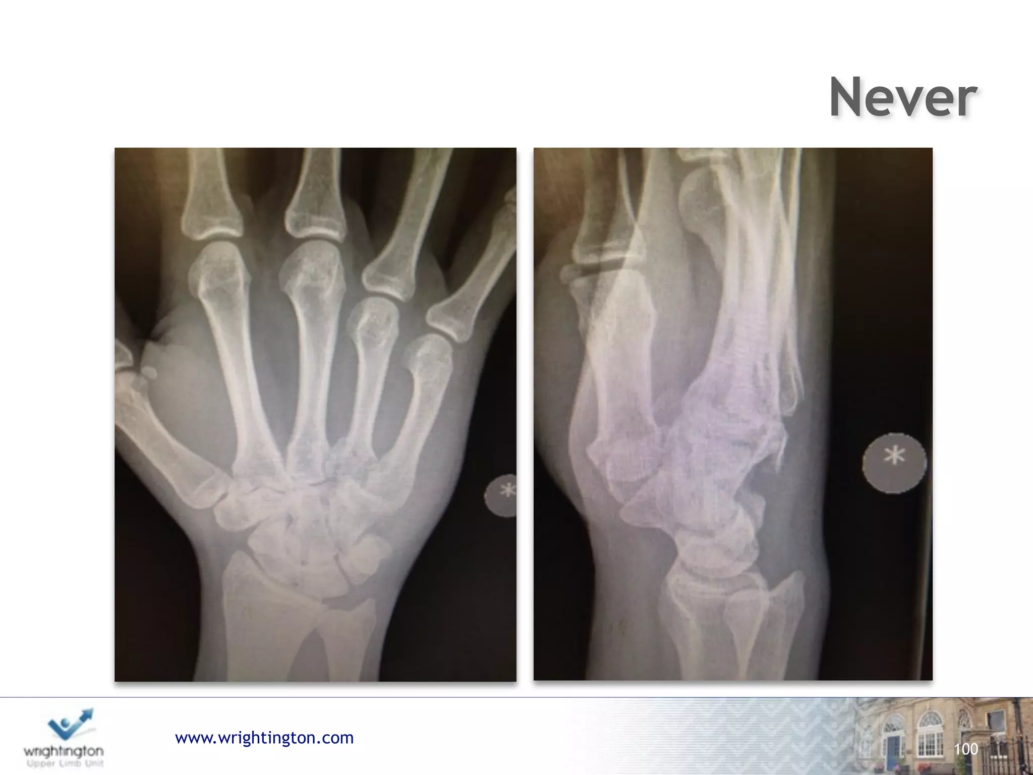 www.wrightington.com
100
Never
 