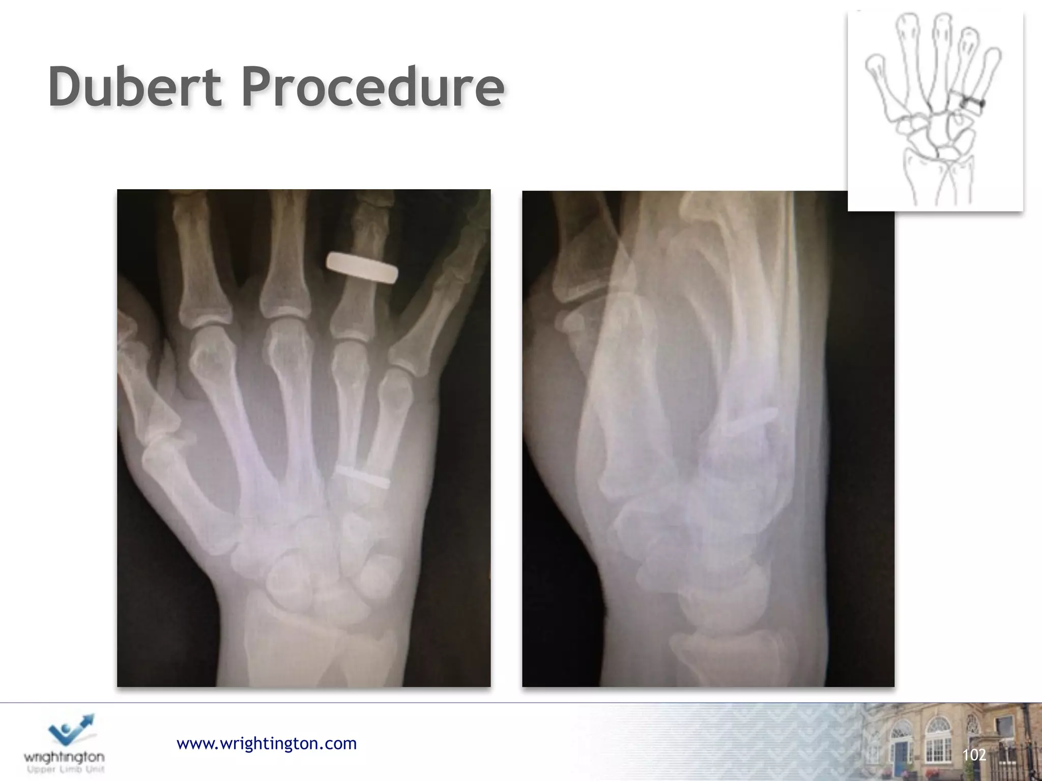 www.wrightington.com
102
Dubert Procedure
 