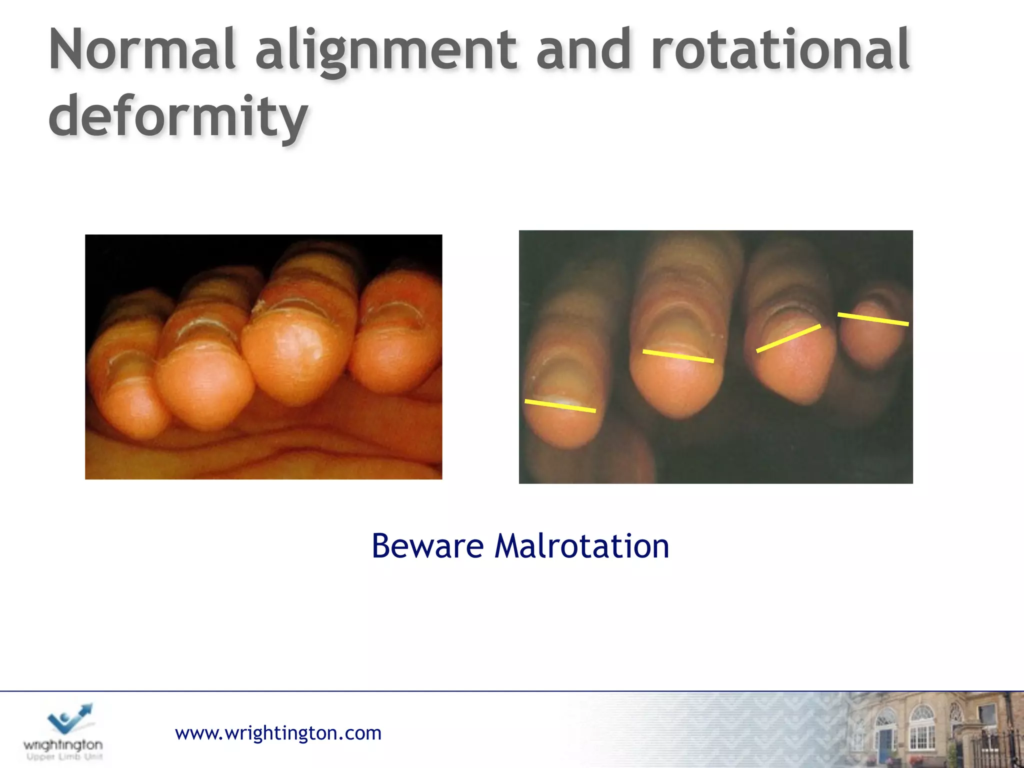 www.wrightington.com
Normal alignment and rotational
deformity
Beware Malrotation
 