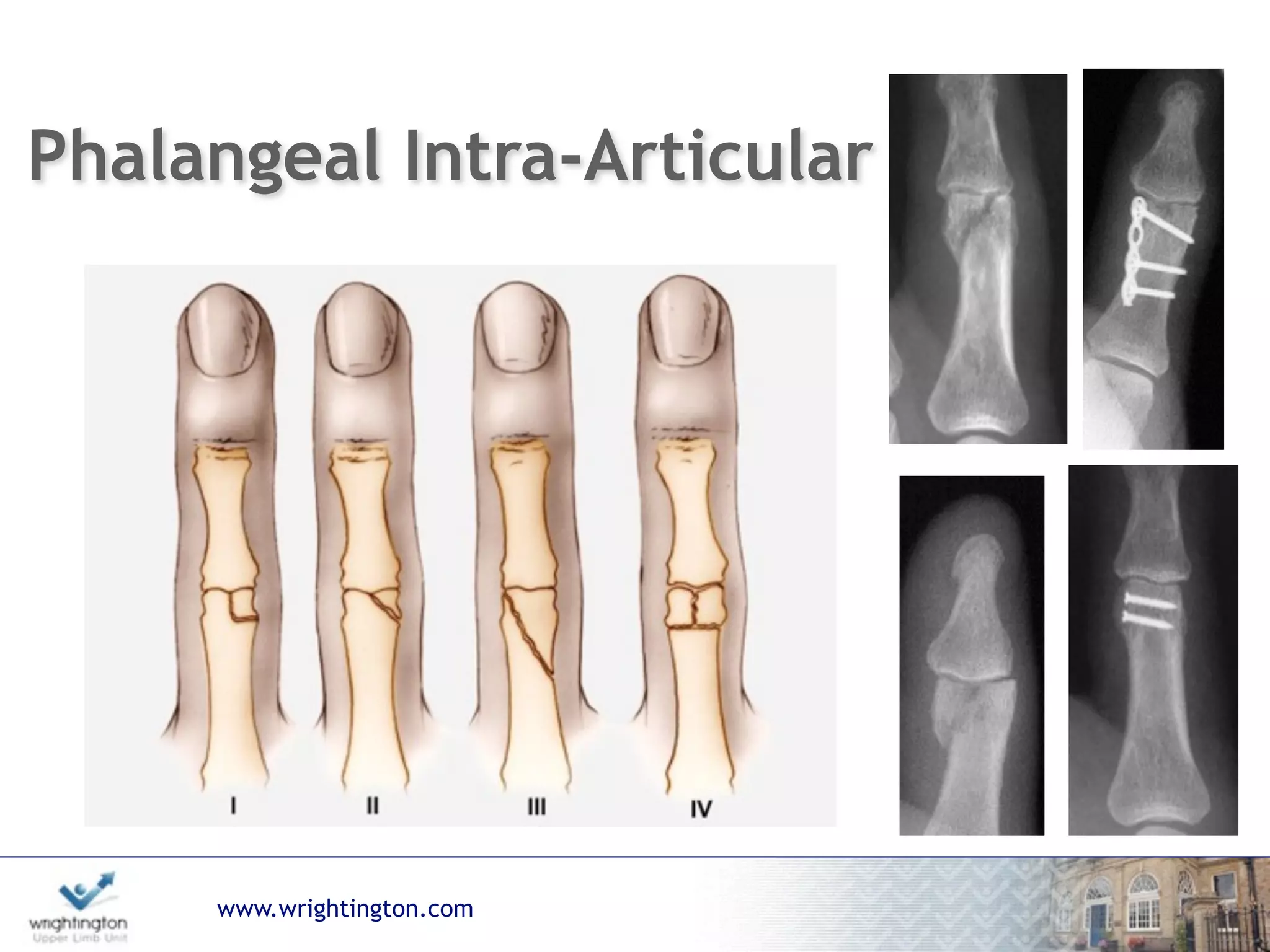 www.wrightington.com
Phalangeal Intra-Articular
 
