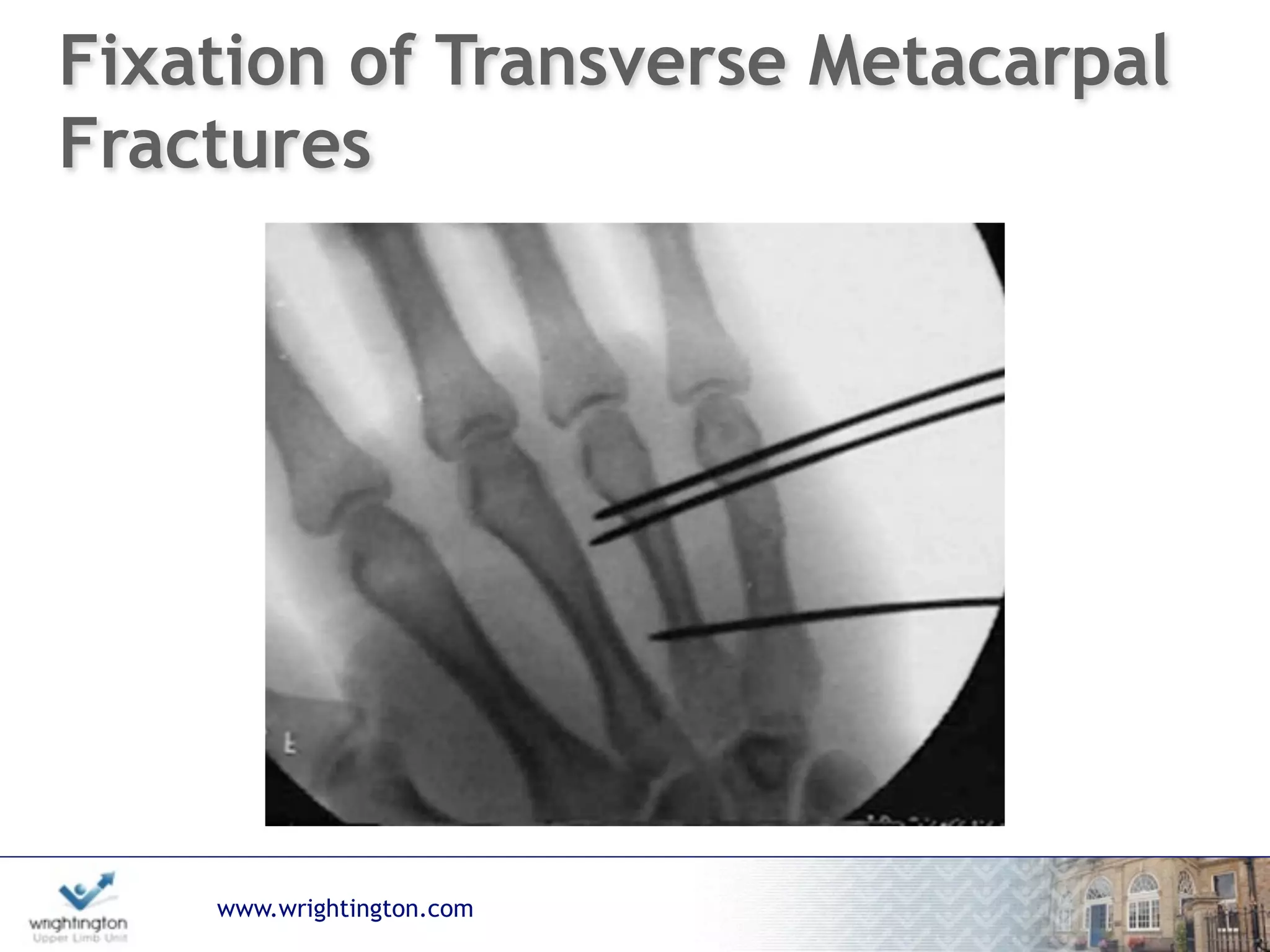 www.wrightington.com
Fixation of Transverse Metacarpal
Fractures
 
