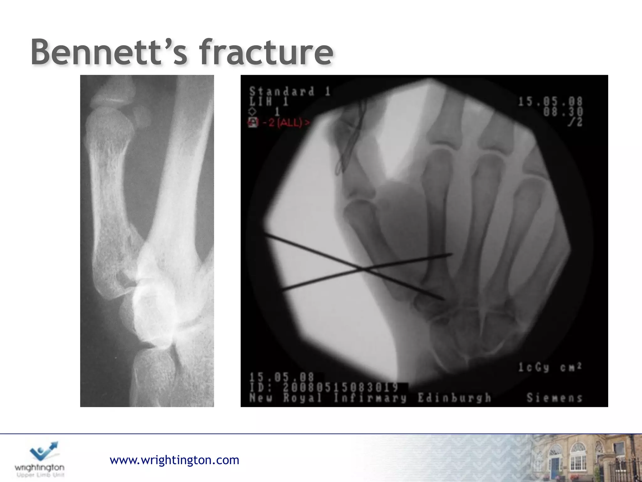 www.wrightington.com
Bennett’s fracture
 