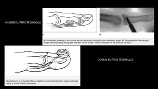 Anchor Incision Pattern Phalangeal fractures of hand | PPTX