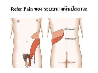 Refer Pain ของ ระบบทางเดินปัสสาวะ
 