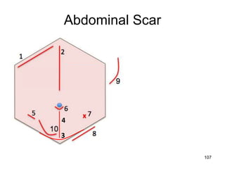 4
3
Abdominal Scar
107
 