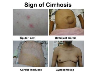 Spider nevi Umbilical hernia
Carput meducae Gynecomastia
Sign of Cirrhosis
 