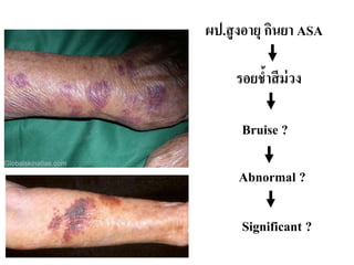 รอยช้าสีม่วง
Bruise ?
Abnormal ?
Significant ?
ผป.สูงอายุ กินยา ASA
 