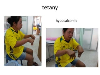 tetany
hypocalcemia
 