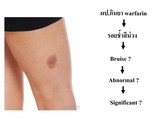 รอยช้าสีม่วง
Bruise ?
Abnormal ?
Significant ?
ผป.กินยา warfarin
 