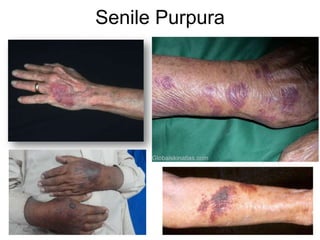Senile Purpura
 