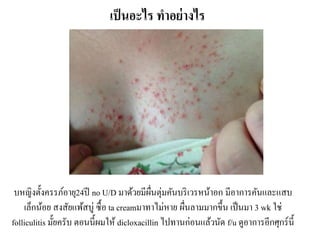 เป็นอะไร ทำอย่ำงไร
บหญิงตั้งครรภ์อายุ24ปี no U/D มาด้วยมีผื่นตุ่มคันบริเวรหน้าอก มีอาการคันและแสบ
เล็กน้อย สงสัยแพ้สบู่ ซื้อ ta creamมาทาไม่หาย ผื่นลามมากขึ้น เป็นมา 3 wk ใช่
folliculitis มั้ยครับ ตอนนี้ผมให้ dicloxacillin ไปทานก่อนแล้วนัด f/u ดูอาการอีกศุกร์นี้
 