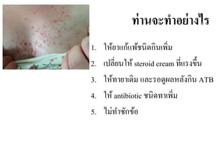 ท่ำนจะทำอย่ำงไร
1. ให้ยาแก้แพ้ชนิดกินเพิ่ม
2. เปลี่ยนให้ steroid cream ที่แรงขึ้น
3. ให้ทายาเดิม และรอดูผลหลังกิน ATB
4. ให้ antibiotic ชนิดทาเพิ่ม
5. ไม่ทาซักข้อ
 