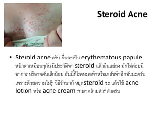 Steroid Acne
• Steroid acne ครับ ผื่นจะเป็น erythematous papule
หน้าตาเหมือนๆกัน มีประวัติทา steroid แล้วผื่นแย่ลง มักไม่ค่อยมี
อาการ หรือาจคันเล็กน้อย อันนี้ก็โรคหมอทาหรือเภสัชทาอีกอันนะครับ
เพราะด้วยความไม่รู้ วิธีรักษาก็ หยุดsteroid ซะ แล้วใช้ acne
lotion หรือ acne cream รักษาคล้ายสิวที่ตัวครับ
 