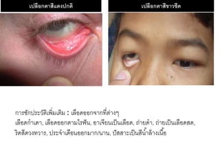 เปลือกตำสีแดงปกติ เปลือกตำสีขำวซีด
การซักประวัติเพิ่มเติม : เลือดออกจากที่ต่างๆ
เลือดกาเดา, เลือดออกตามไรฟัน, อาเจียนเป็นเลือด, ถ่ายดา, ถ่ายเป็นเลือดสด,
ริดสีดวงทวาร, ประจาเดือนออกมาก/นาน, ปัสสาะเป็นสีน้าล้างเนื้อ
 
