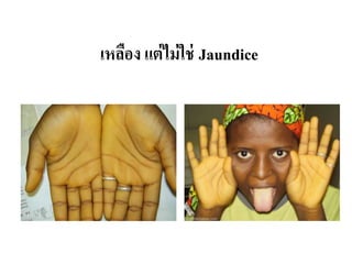 เหลือง แต่ไม่ใช่ Jaundice
 