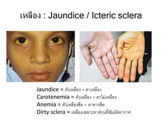 เหลือง : Jaundice / Icteric sclera
Jaundice = ตัวเหลือง + ตาเหลือง
Carotenemia = ตัวเหลือง + ตาไม่เหลือง
Anemia = ตัวเหลืองซีด + ตาขาวซีด
Dirty sclera = เหลืองเฉพาะตาส่วนที่สัมผัสอากาศ
 