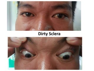 Dirty Sclera
 