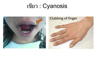 เขียว : Cyanosis
Clubbing of finger
 