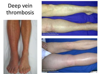 Deep vein
thrombosis
 