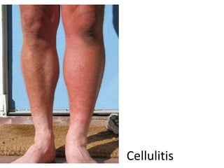 Cellulitis
 