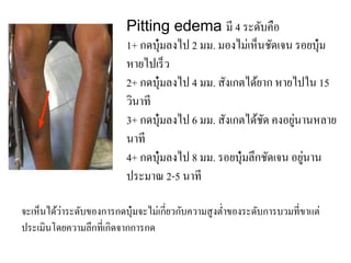 จะเห็นได้ว่ำระดับของกำรกดบุ๋มจะไม่เกี่ยวกับควำมสูงต่ำของระดับกำรบวมที่ขำแต่
ประเมินโดยควำมลึกที่เกิดจำกกำรกด
Pitting edema มี 4 ระดับคือ
1+ กดบุ๋มลงไป 2 มม. มองไม่เห็นชัดเจน รอยบุ๋ม
หำยไปเร็ว
2+ กดบุ๋มลงไป 4 มม. สังเกตได้ยำก หำยไปใน 15
วินำที
3+ กดบุ๋มลงไป 6 มม. สังเกตได้ชัด คงอยู่นำนหลำย
นำที
4+ กดบุ๋มลงไป 8 มม. รอยบุ๋มลึกชัดเจน อยู่นำน
ประมำณ 2-5 นำที
 