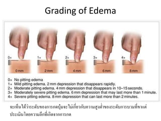 Grading of Edema
จะเห็นได้ว่ำระดับของกำรกดบุ๋มจะไม่เกี่ยวกับควำมสูงต่ำของระดับกำรบวมที่ขำแต่
ประเมินโดยควำมลึกที่เกิดจำกกำรกด
 