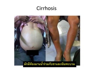Cirrhosis
มักมีท้องมำนน้ำร่วมกับขำและอัณฑะบวม
 