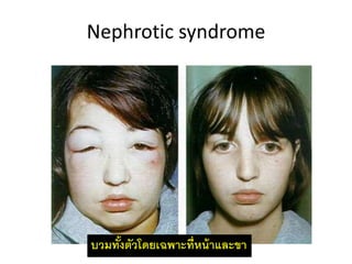 Nephrotic syndrome
บวมทั้งตัวโดยเฉพำะที่หน้ำและขำ
 
