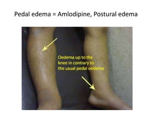 Pedal edema = Amlodipine, Postural edema
 