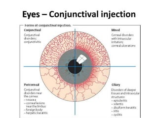 Eyes – Conjunctival injection
 