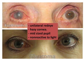 - unilateral redeye
- hazy cornea.
- mid sized pupil
- nonreactive to light
 