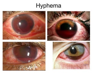 Hyphema
 