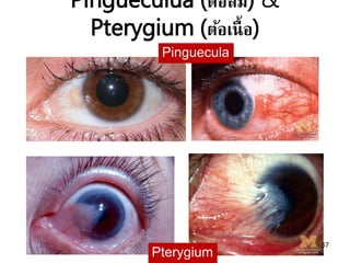 Pingueculua (ต้อลม) &
Pterygium (ต้อเนื้อ)
57
Pinguecula
Pterygium
 